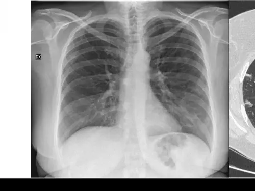 Ecco la radiografia al torace che svela la bomba Covid negli asintomatici 