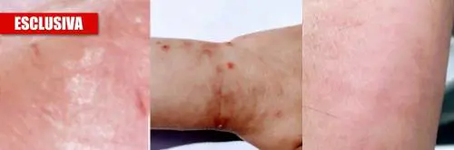 Ecco la verità sul coronavirus: "Pelle esposta nel 45% dei casi"