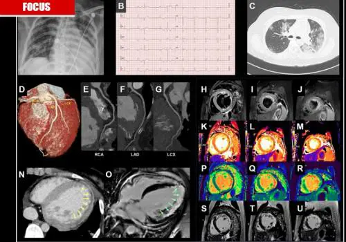 Covid-19, triplicati i morti per infarto. Ma è tutta colpa del virus?