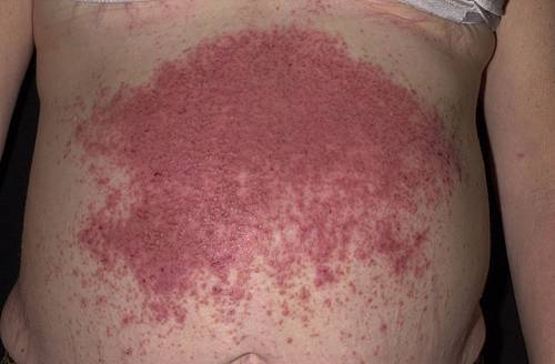 Dermatite erpetiforme, quali sono le cause