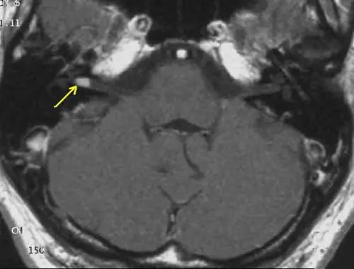 Neurinoma acustico, cos'è e come si manifesta?