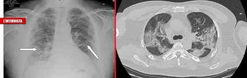 La forza "feroce" del Covid: "Rompe i muri dei polmoni"