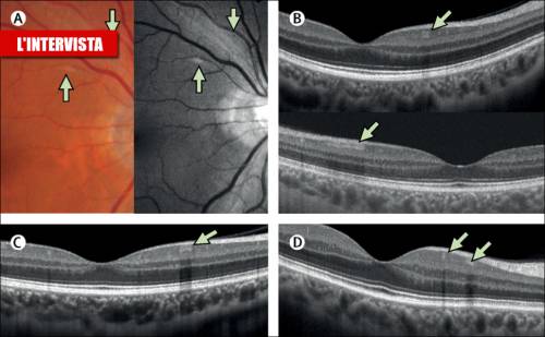 Risultati della retina in 4 pazienti Covid