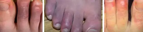 "Quelle lesioni anche per i negativi" Così Covid "mangia" la pelle