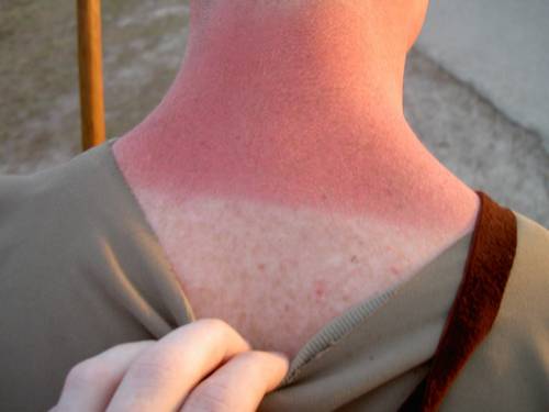 Eritema solare,  ecco alcuni rimedi per curare la pelle
