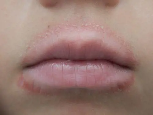 Dermatite periorale: come riconoscerla ​(E cosa fare subito)