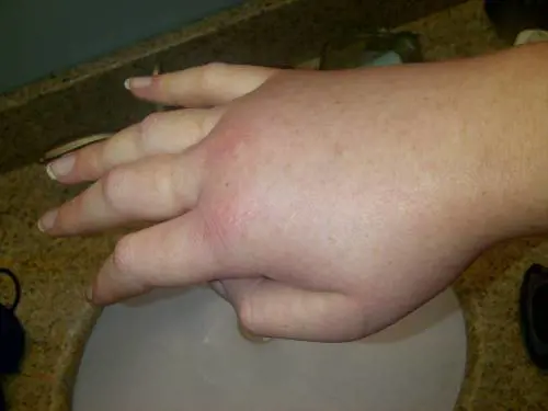 Angioedema ereditario, come si manifesta questa malattia rara?