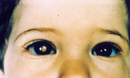 Retinoblastoma, cos'è e quali sono i sintomi