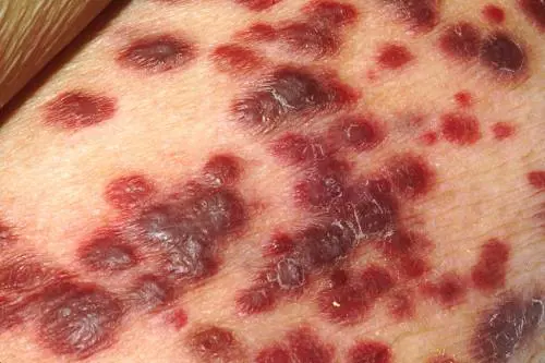 Sarcoma, di cosa si tratta e come si manifesta