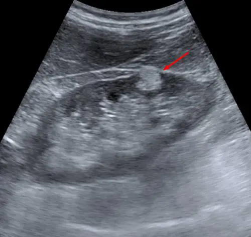 Angiomiolipoma renale: cos'è e come si manifesta