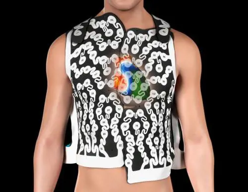 Aritmie cardiache, pazienti trattati con radioterapia anti cancro