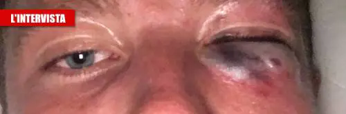 Aggressione in centro: "Un pugno nell'occhio per rubare"