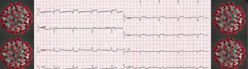 Paura per la sindrome Takotsubo: che cosa accade con il Covid