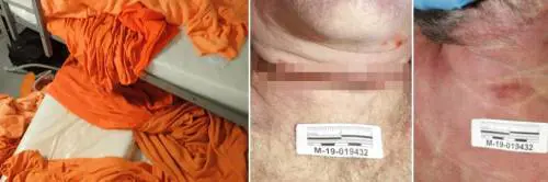 I segni sul collo e il "sonno" . Un anno di misteri su Epstein