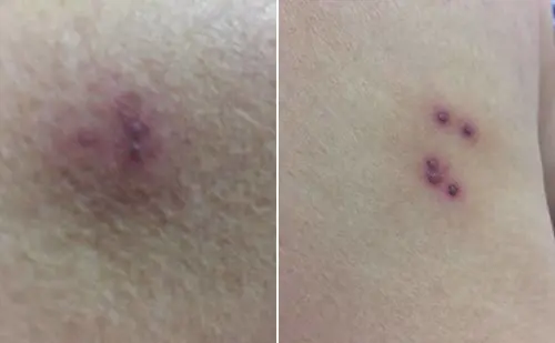 Donna morsa da ragno violino in pineta "Ecco come mi ha ridotta"