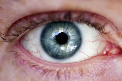 Usa, giovane fissa un puntatore laser per alcuni secondi: perde parte della retina