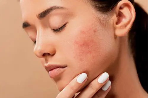 Rosacea o couperose, ecco come si manifesta