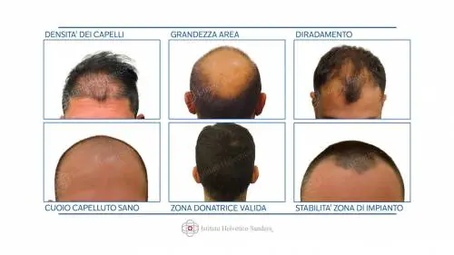 Trapianto di capelli, in Italia è meglio che all'estero?