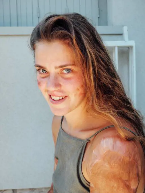 "Con le mie cicatrici sono una bellezza unica. E ora ho fame di vita"