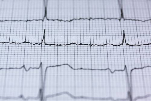 Mavacamtem, i benefici sui pazienti con cardiomiopatia ipertrofica ostruttiva