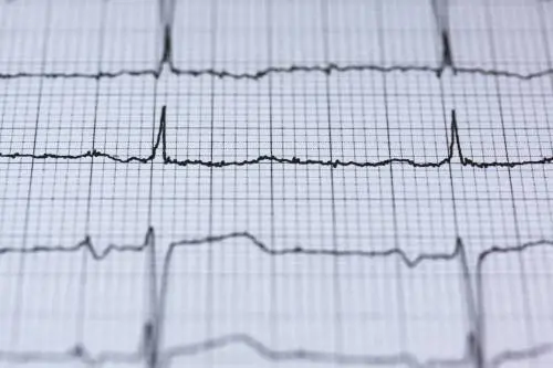 Infarto, attenzione al lunedì: è il giorno in cui c'è più probabilità di averlo. Ecco perché