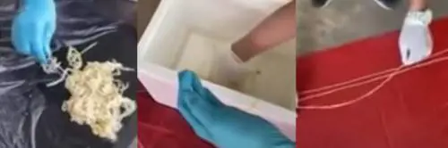 Un verme di 18 metri in pancia. ​La scoperta choc su un anziano