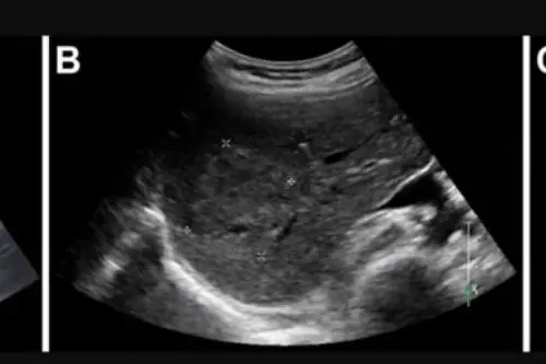 Tumore del fegato, ecco come "prevedere" il suo sviluppo