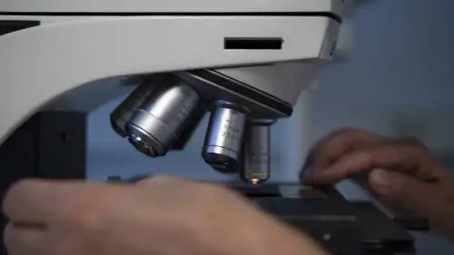 Tumori aggressivi, meno movimento delle cellule limita le metastasi