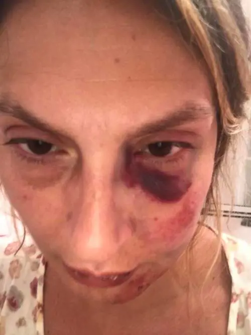 "Tutti guardavano, nessuno mi aiutava...". La brutale aggressione in spiaggia