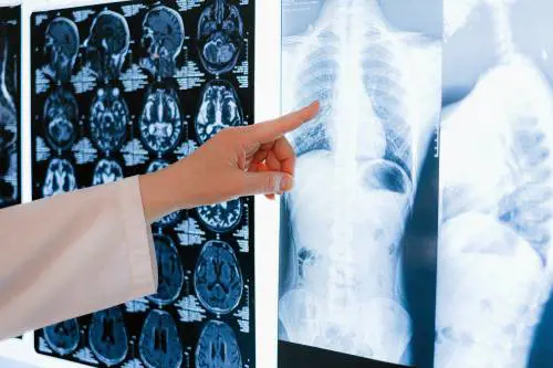 Tumore al polmone, scoperto meccanismo resistente all'immunoterapia