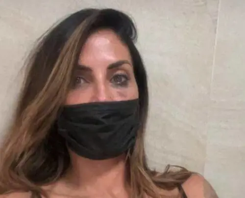 Aggressione a Guendalina Tavassi: "Frattura del naso e contusioni multiple"