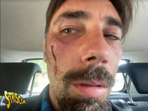 Brumotti aggredito e pestato a Foggia: trauma facciale e prognosi di 30 giorni