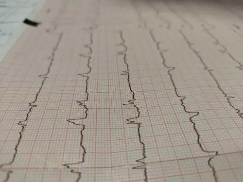 Infarto, qual è la proteina che "ripulisce" le arterie del cuore