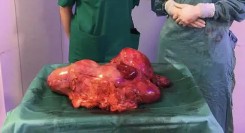 Il tumore di 7,5 chili 