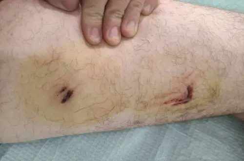 Aggredito da un pitbull nell'area dello spaccio: "Mentre mi mordeva i tossici ridevano"