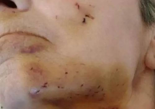 Topo "mangia il viso" a una disabile paralizzata a letto