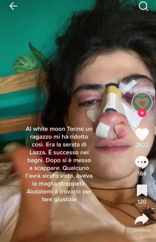 Difende il fidanzato e le rompono il naso: "Aiutatemi a trovarli"