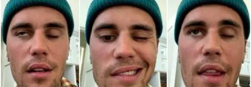 La sindrome di Hunt: ecco cos'è la paralisi di cui soffre Justin Bieber