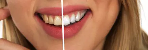 Faccette dentali, il "miracolo" per un sorriso perfetto