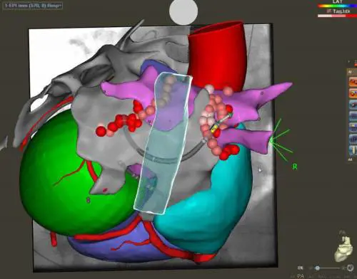 Fibrillazione cardiaca, si apre una nuova strada: l'intervento è rivoluzionario