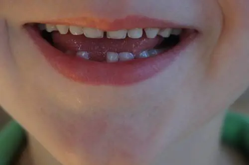 Denti da latte, tutto quello che i genitori devono sapere