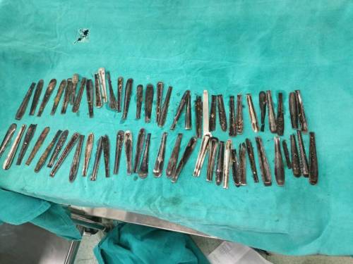 I medici gli trovano 63 cucchiai nello stomaco: cosa è successo all’indiano