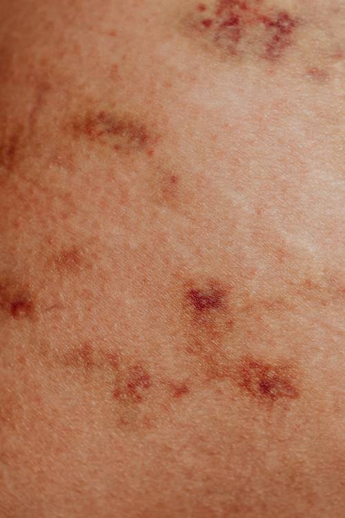 Macchie rosse sulla pelle: cause, rimedi e cure