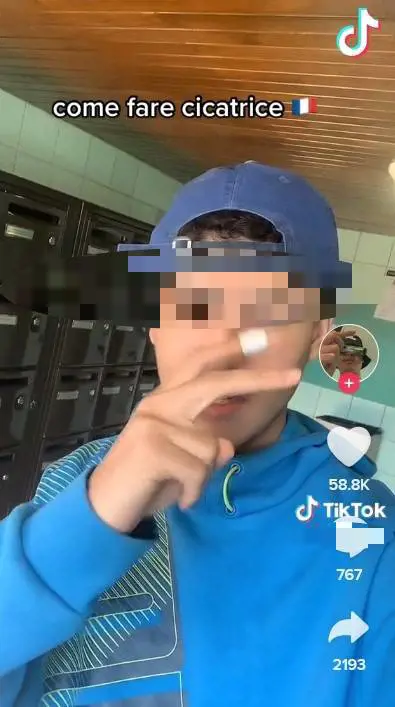 La moda della "cicatrice alla francese" fa paura: e TikTok finisce nei guai