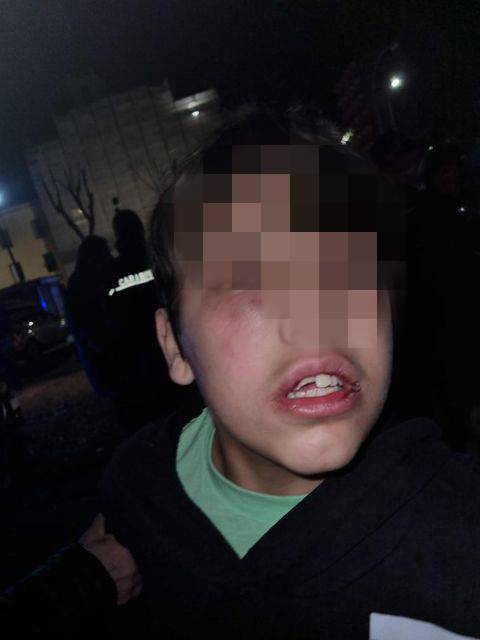 Napoli, pestato con un tirapugni dai coetanei: l'orrore su un bimbo di 11 anni