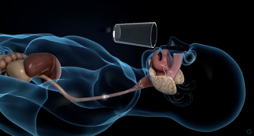 Gastroscopia con videocapsula: anteprima mondiale al Gemelli