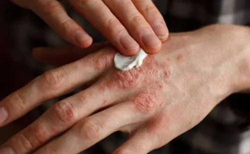 Focus su psoriasi e dermatite seborroica