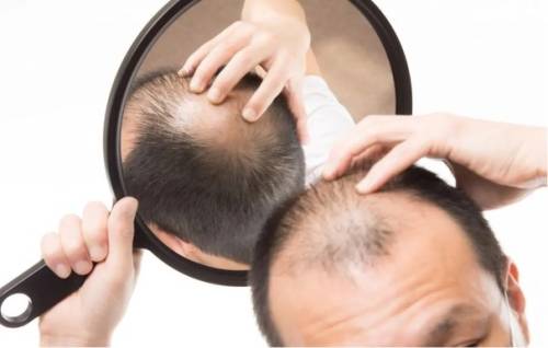 Caduta dei capelli nell'uomo: le cause e i rimedi 