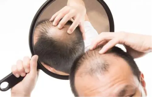 Caduta dei capelli nell'uomo: le cause e i rimedi 