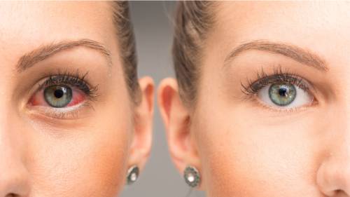 Congiuntivite e occhio rosso: differenze e cure